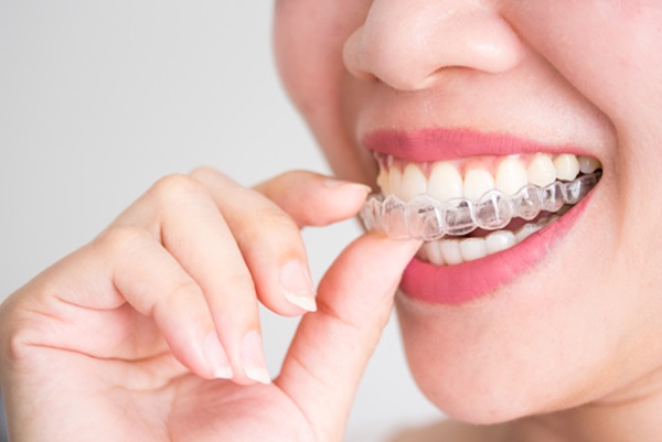 Niềng răng không mắc cài trong suốt giá bao nhiêu?