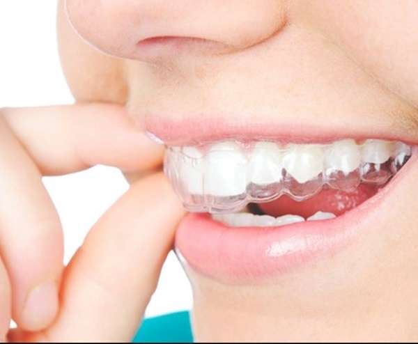Niềng răng không mắc cài trong suốt giá bao nhiêu?