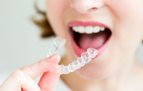 Niềng răng không mắc cài trong suốt giá bao nhiêu?