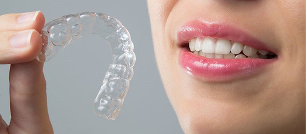 Niềng răng không mắc cài trong suốt giá bao nhiêu?