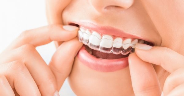Niềng răng giá bao nhiêu trong năm 2022?