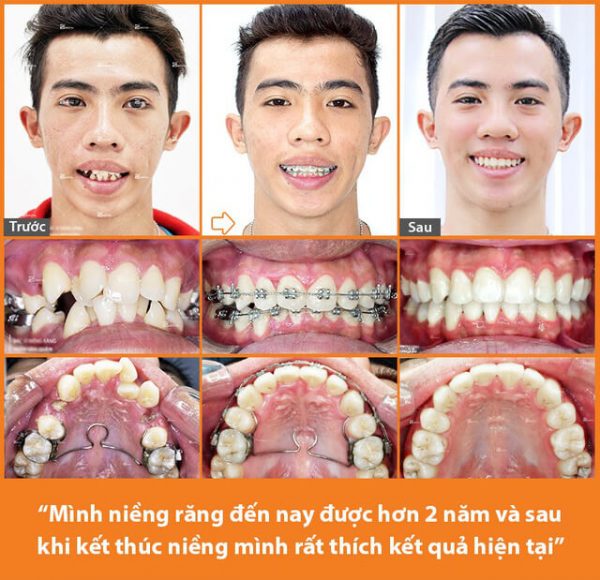 Niềng răng giá bao nhiêu trong năm 2022?