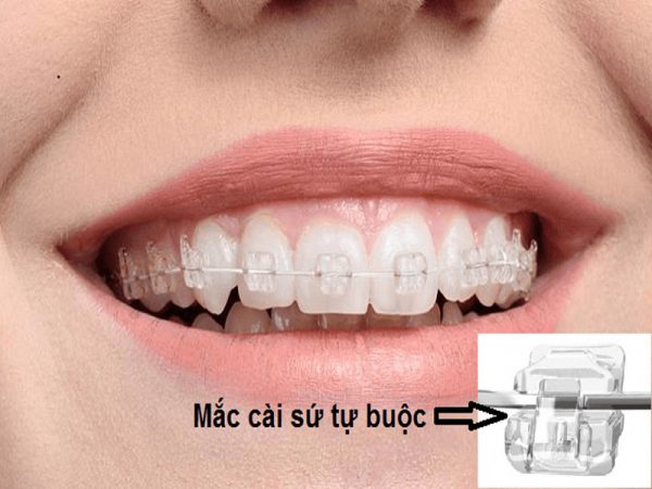Chi phí niềng răng mắc cài sứ năm 2022 - Nha khoa Platinum