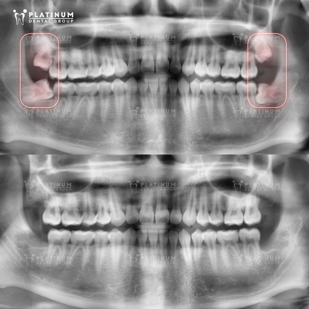 Bản chất nhổ răng số 8 không nguy hiểm nếu đúng chỉ định