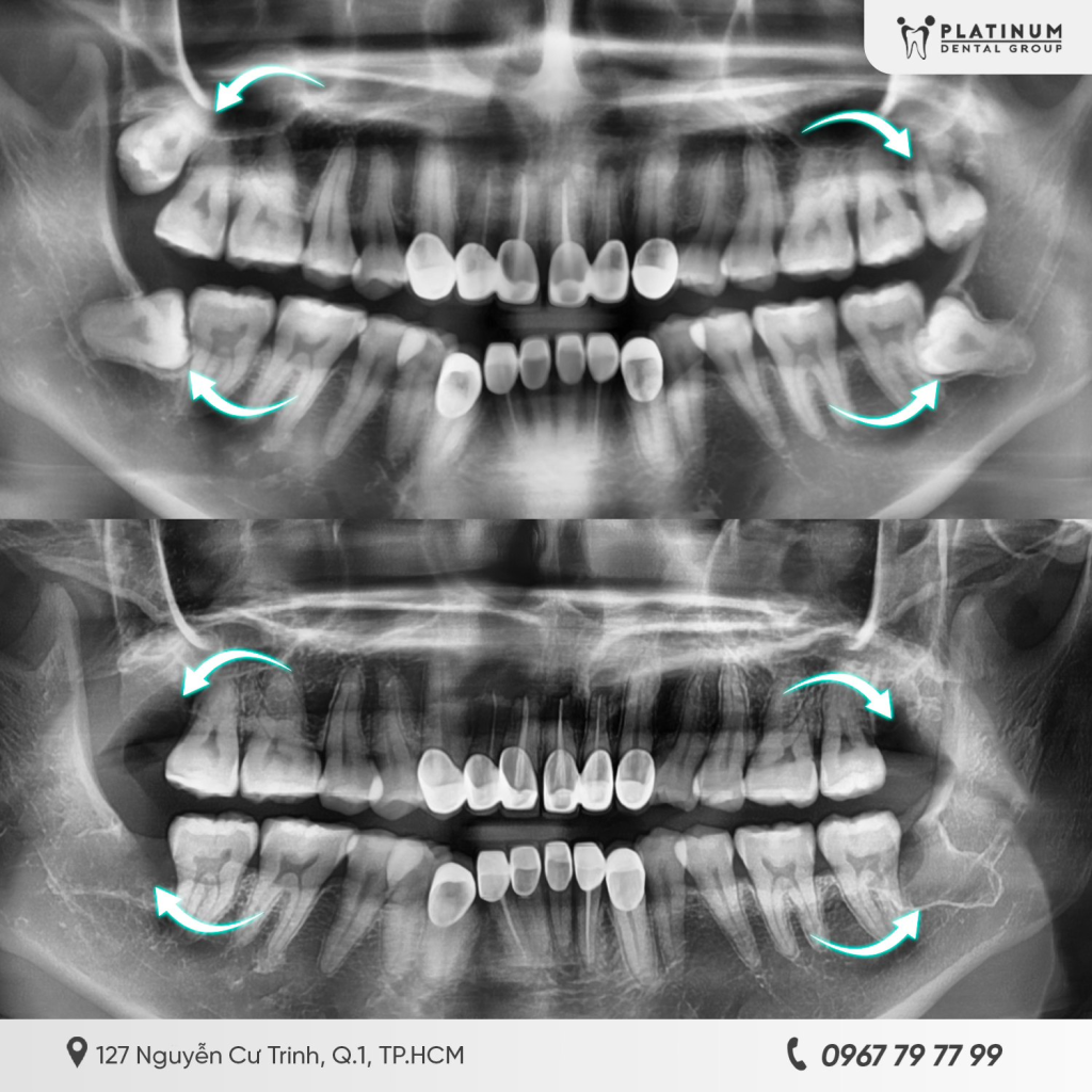 Nếu phim X-quang hoặc CT 3D cho thấy răng số 8 mọc lệch, mọc ngang, mọc ngầm sâu thì bạn nên nhổ răng khôn