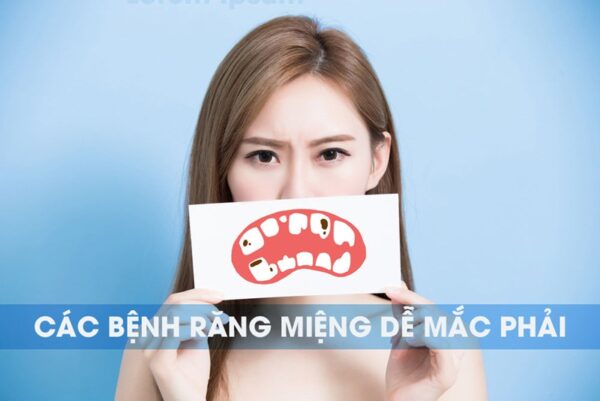 Bệnh sâu răng – căn bệnh cực kỳ phổ biến