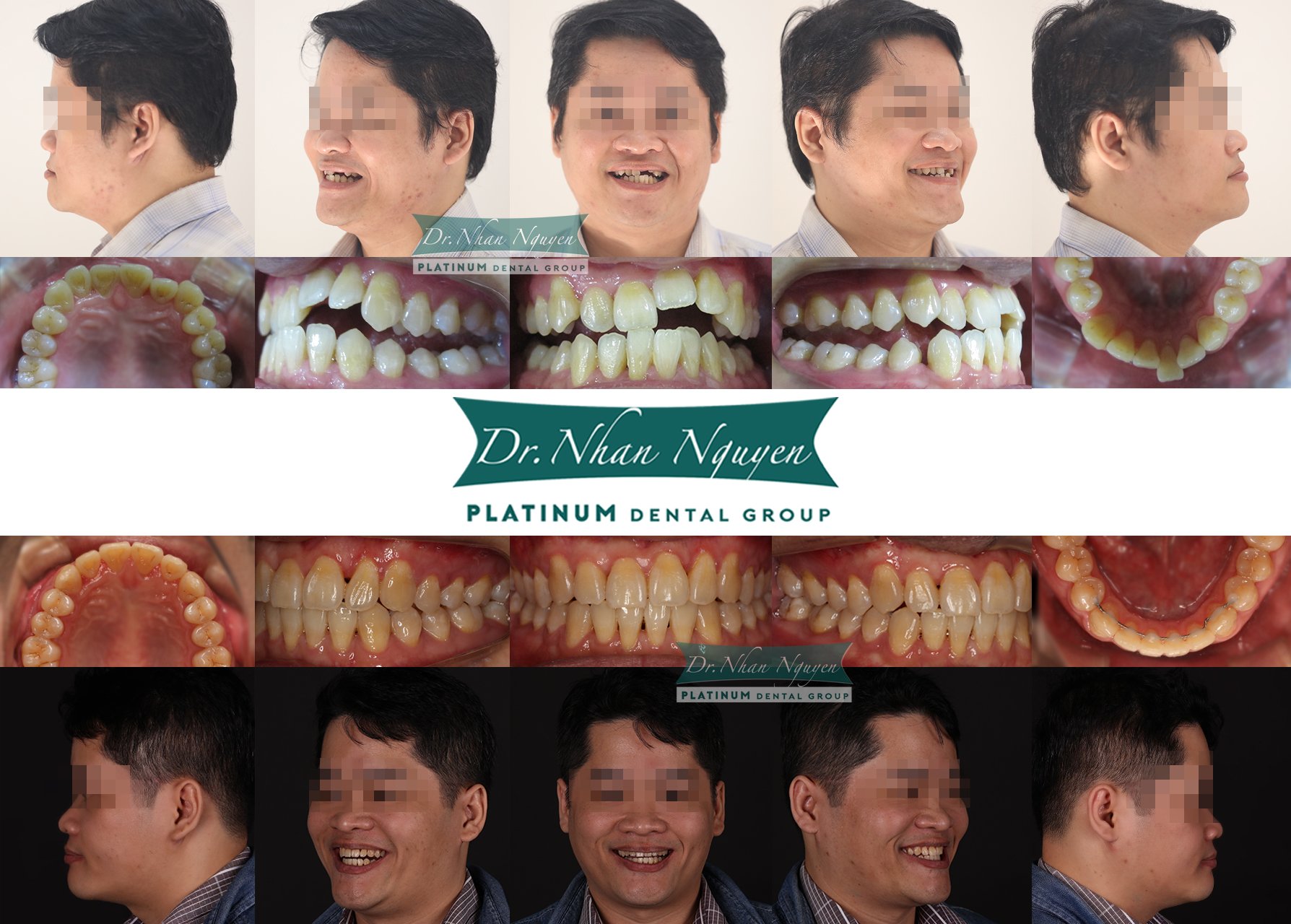 Tôi rất vui mừng và tự tin với nụ cười mới 2 Platinum Gallery 1