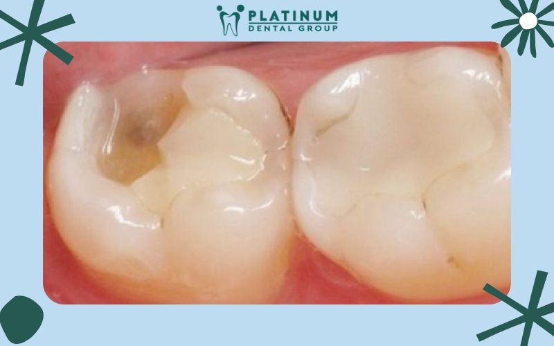 Hình ảnh chụp tình trạng răng bị bể