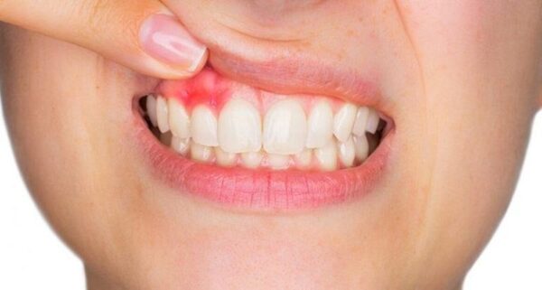Viêm nha chu là gì? Phương pháp điều trị 21 Viêm nha chu xuất hiện phổ biến ở nhiều người Việt