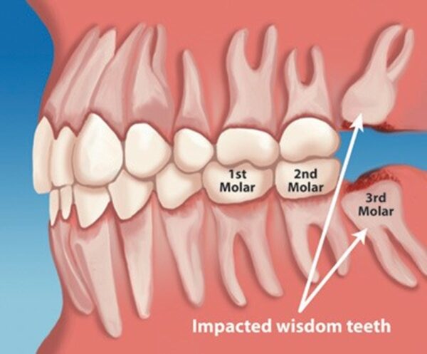 Có nên nhổ răng khôn mọc lệch hay không? 22 Vị trí răng khôn ở trong hàm
