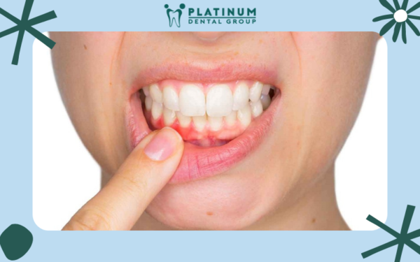 Nguyên nhân gây viêm chân răng và cách điều trị hiệu quả 22 Viêm chân răng là bệnh lý gì?