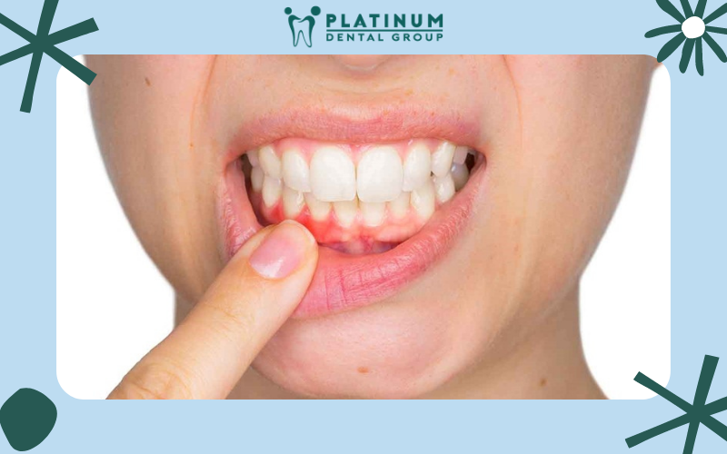 Viêm chân răng là bệnh lý gì?