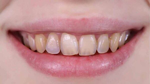 5 Nguyên nhân bị nhức sau khi trồng răng 24 Men răng yếu có thể do di truyền hoặc chăm sóc không đúng cách