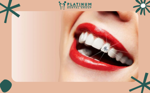 Làm răng đính kim cương có thực sự tốt? 21 Làm răng đính kim cương có thực sự tốt?
