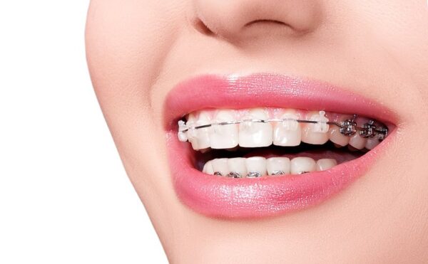Niềng răng không đau như lời đồn