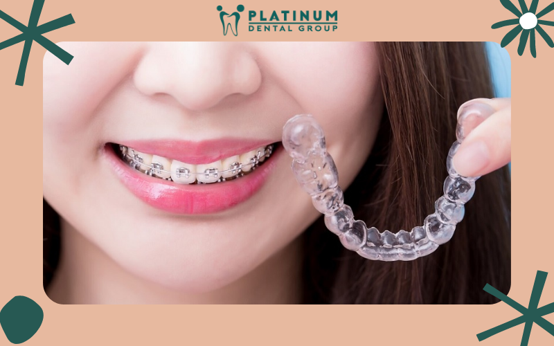 Phương pháp niềng răng mắc cài và trong suốt