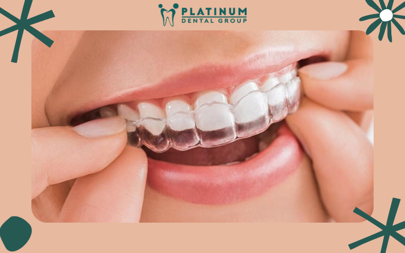 Ưu điểm phương pháp niềng răng mắc cài và trong suốt