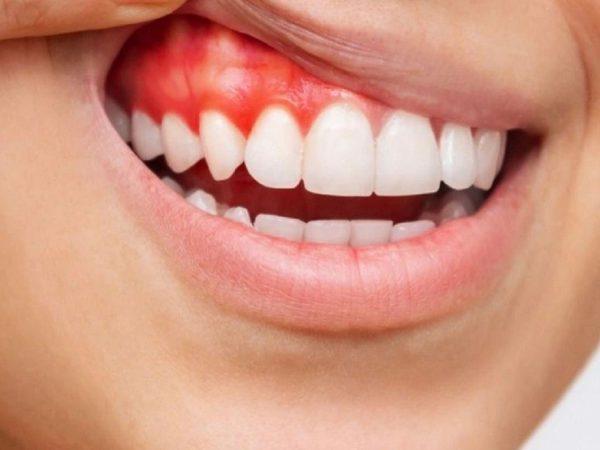 Crown Sensitivity When Pre-existing Dental Issues Were Not Fully Treated Before Placement