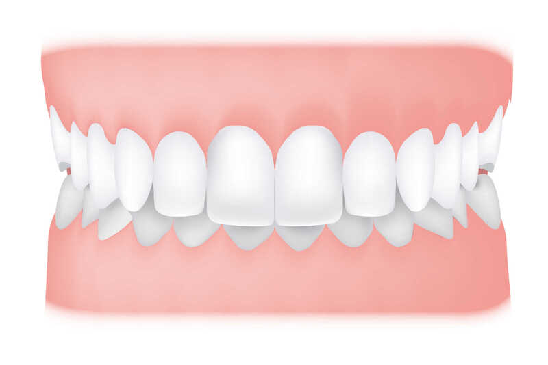 chinh-rang-ho-khong-can-nieng-1