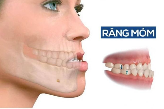 Răng Xấu Phải Làm Sao? Cách Chữa Răng Xấu Trở Nên Đẹp Và Thẩm Mỹ Hơn