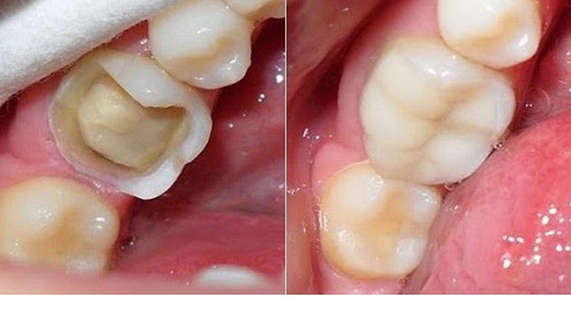 Hàn răng sâu hay còn gọi là trám răng sâu là phương pháp thường được áp dụng khi chữa sâu răng.