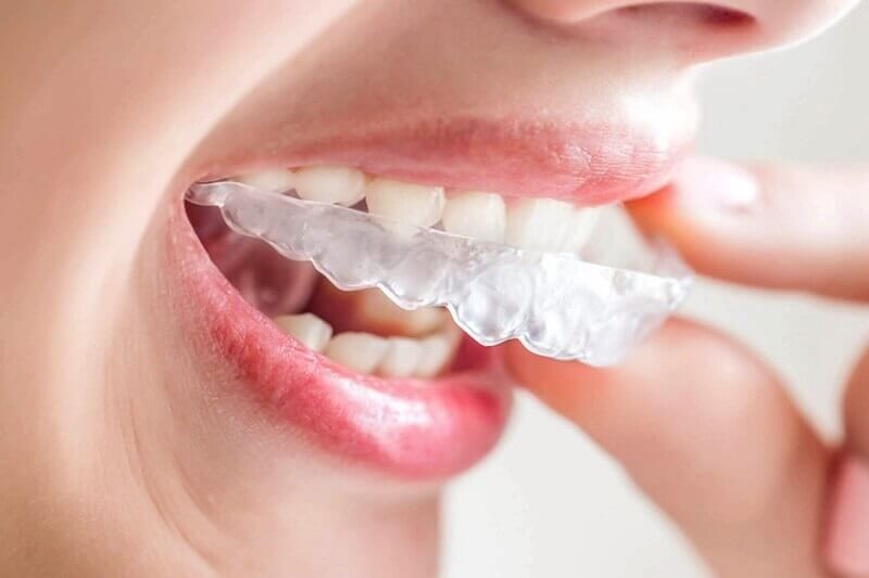 Bên cạnh đó niềng răng Invisalign còn dễ dàng được tháo lắp những vẫn đảm bảo hiệu quả cải thiện khớp cắn. 