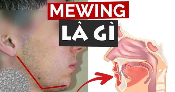 Hướng dẫn tư thế đặt lưỡi đúng đúng khi tập Mewing hiệu quả 20 Mewing được biết đến là phương pháp làm thon gọn, thanh thoát hơn cho hàm mặt rất hiệu quả ở các nước Âu, Mỹ.
