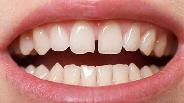 Tư thế đặt lưỡi sai kéo dài có thể là một trong những nguyên nhân khiến cho răng bị thưa và tình trạng nghiêm trọng hơn theo thời gian