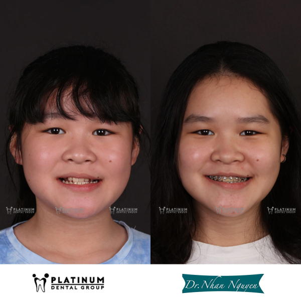 Bệnh nhân có khớp cắn ngược không nên tập mewing