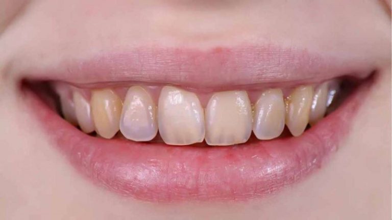 Men Răng Là Gì? Top 5 Cách Khắc Phục Tình Trạng Men Răng Yếu