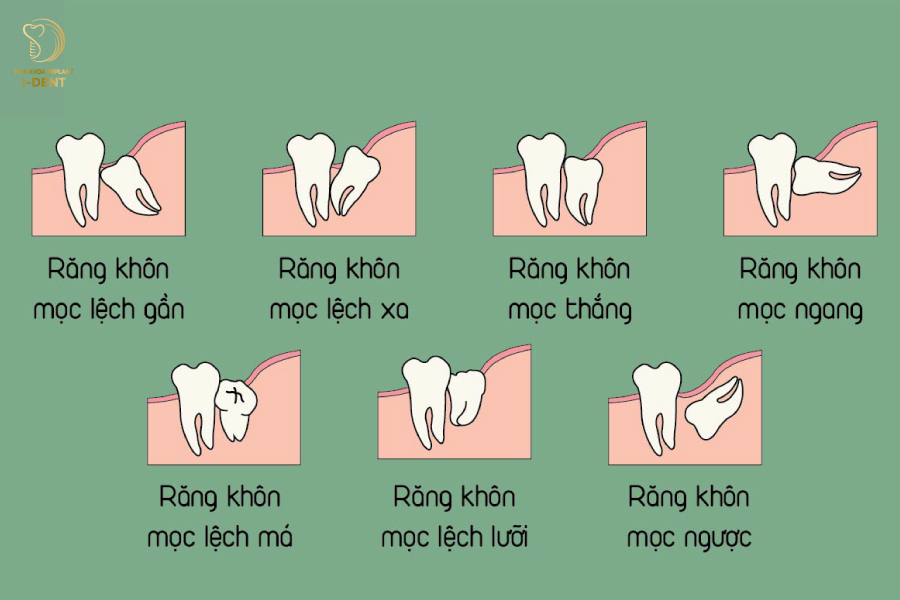 Răng không sâu nhưng bị đau là dấu hiệu gì? Cách xử lý