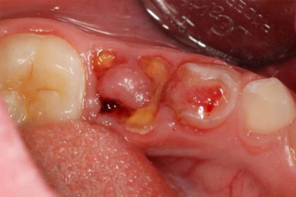 Răng sâu vỡ chỉ còn chân răng có thể khiến những chiếc răng khác trên hàm bị ảnh hưởng nghiêm trọng 