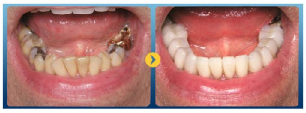 Bọc sứ cho răng sâu bị vỡ chỉ còn chân răng là sự lựa chọn được nhiều chuyên gia lựa chọn 