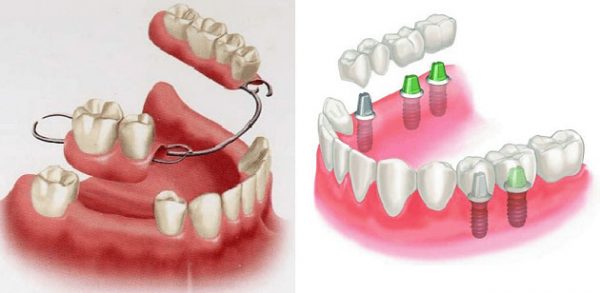 Khi răng sâu quá nghiêm trọng không còn khả năng giữ chân răng, bạn có thể lắp răng giả để thay thế 