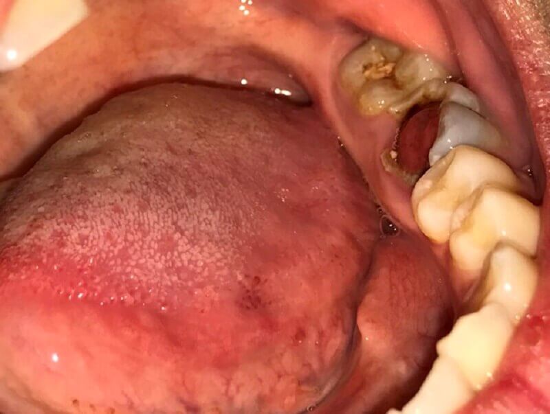 Răng sâu lồi thịt là tình trạng sâu răng nghiêm trọng và cần được chữa trị sớm