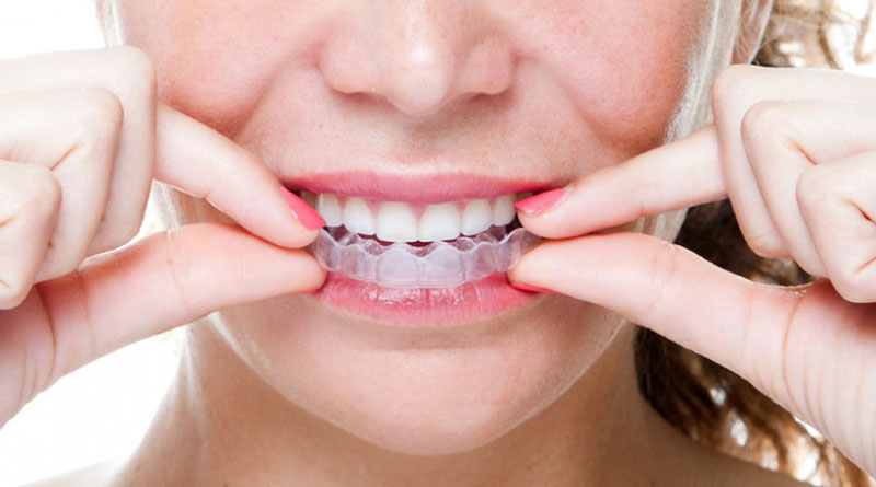 Niềng răng Invisalign mất bao lâu để hoàn thiện? 1 Thời gian niềng răng Invisalign mất bao lâu?