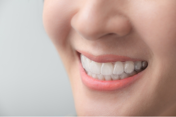 Ưu và nhược điểm khi sử dụng phương pháp niềng răng Invisalign
