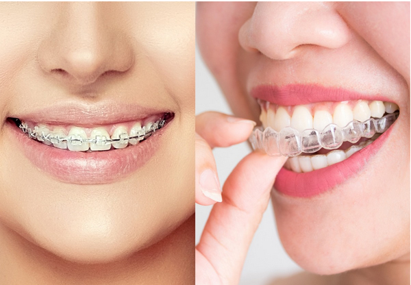 Niềng răng Invisalign là thế nào ?