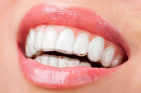 Niềng răng Invisalign có cách thức hoạt động ra sao?