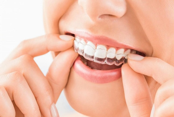 Thời gian niềng răng Invisalign có lâu hơn các phương pháp khác ?