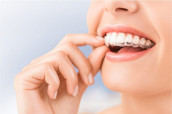 Quy trình thực hiện niềng răng Invisalign như thế nào?