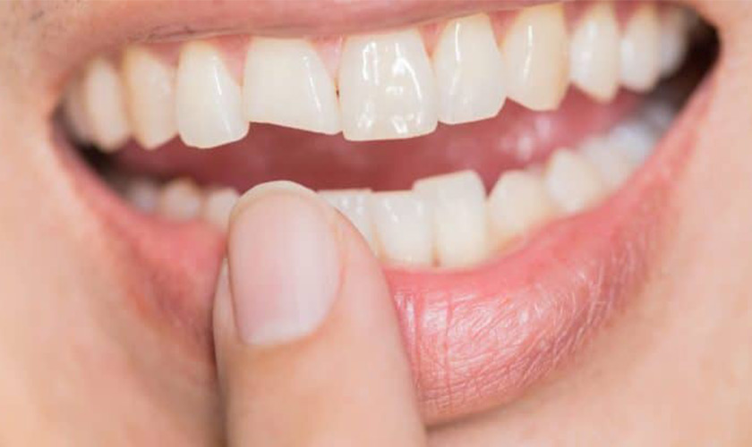 Mặt dán sứ mẻ, bị vỡ phải làm sao để khắc phục? Mặt dán sứ mẻ, bị vỡ phải làm sao để khắc phục?