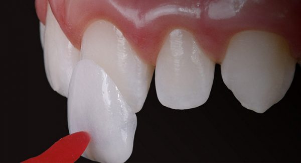 Mặt dán sứ bị mẻ có thể do nhiều nguyên nhân gây ra Mặt dán sứ bị mẻ có thể do nhiều nguyên nhân gây ra
