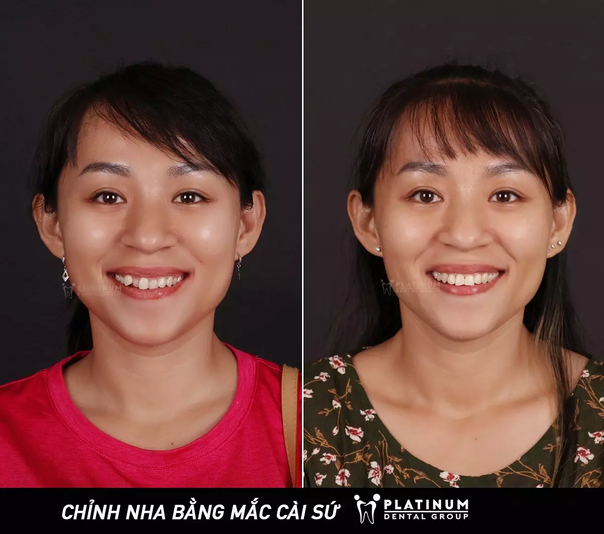 Diện mạo thay đổi chỉ sau 1,5 năm kiên trì niềng răng 2 CauChuyenPlatinum-3