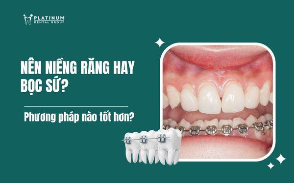nên niềng răng hay bọc sứ
