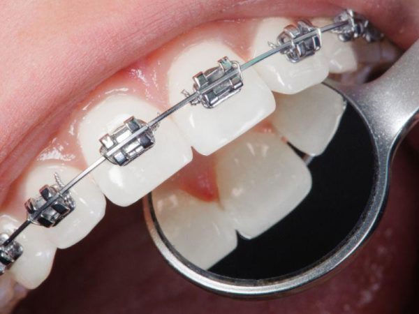 Nên niềng răng hay bọc sứ? Phương pháp nào tốt hơn? 1 Tìm hiểu ưu và nhược điểm của phương pháp niềng răng