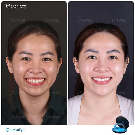 Nên niềng răng hay bọc sứ? Phương pháp nào tốt hơn? 7 Hình ảnh răng của Hằng trước và sau khi niềng răng tại Platinum Dental Group