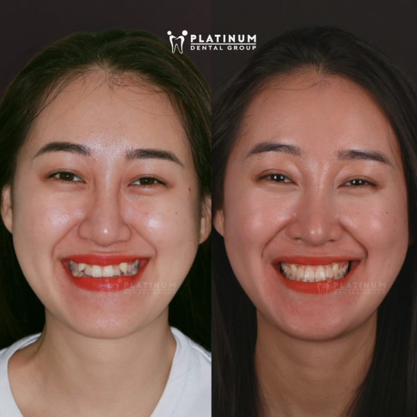 Nên niềng răng hay bọc sứ? Phương pháp nào tốt hơn? 6 Hình ảnh khuôn mặt của Hương Ly trước và sau khi niềng răng tại Platinum Dental Group