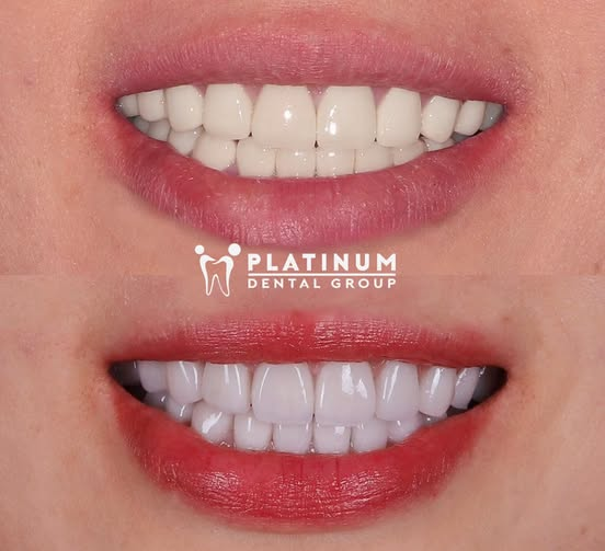 Nên niềng răng hay bọc sứ? Phương pháp nào tốt hơn? 9 Hàm răng chị T được Dr. Anna thiết kế hài hoà với khuôn mặt