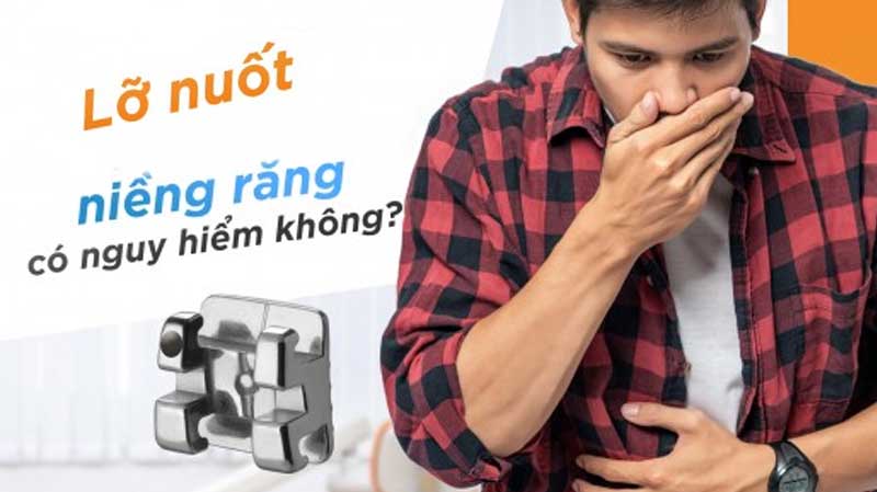 Hạn chế rơi niềng răng với những quy tắc trên